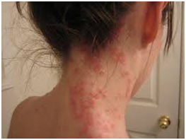 Herpetiformni dermatitis 