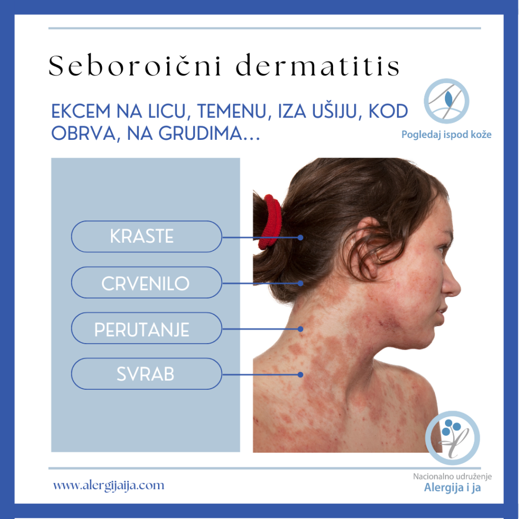seboroični dermatitis